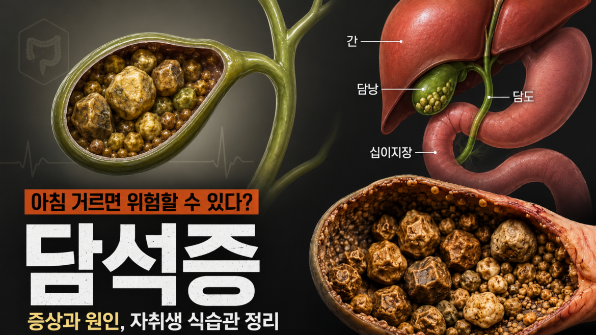 담석증 증상과 원인 및 자취생 식습관을 설명